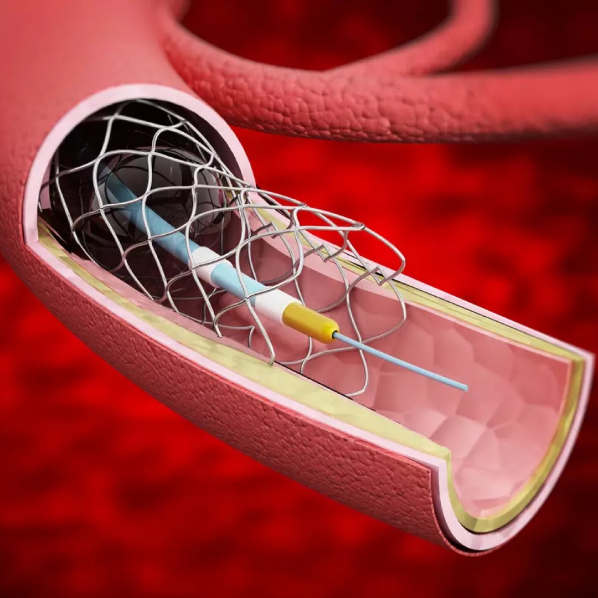 Stent Uygulamaları